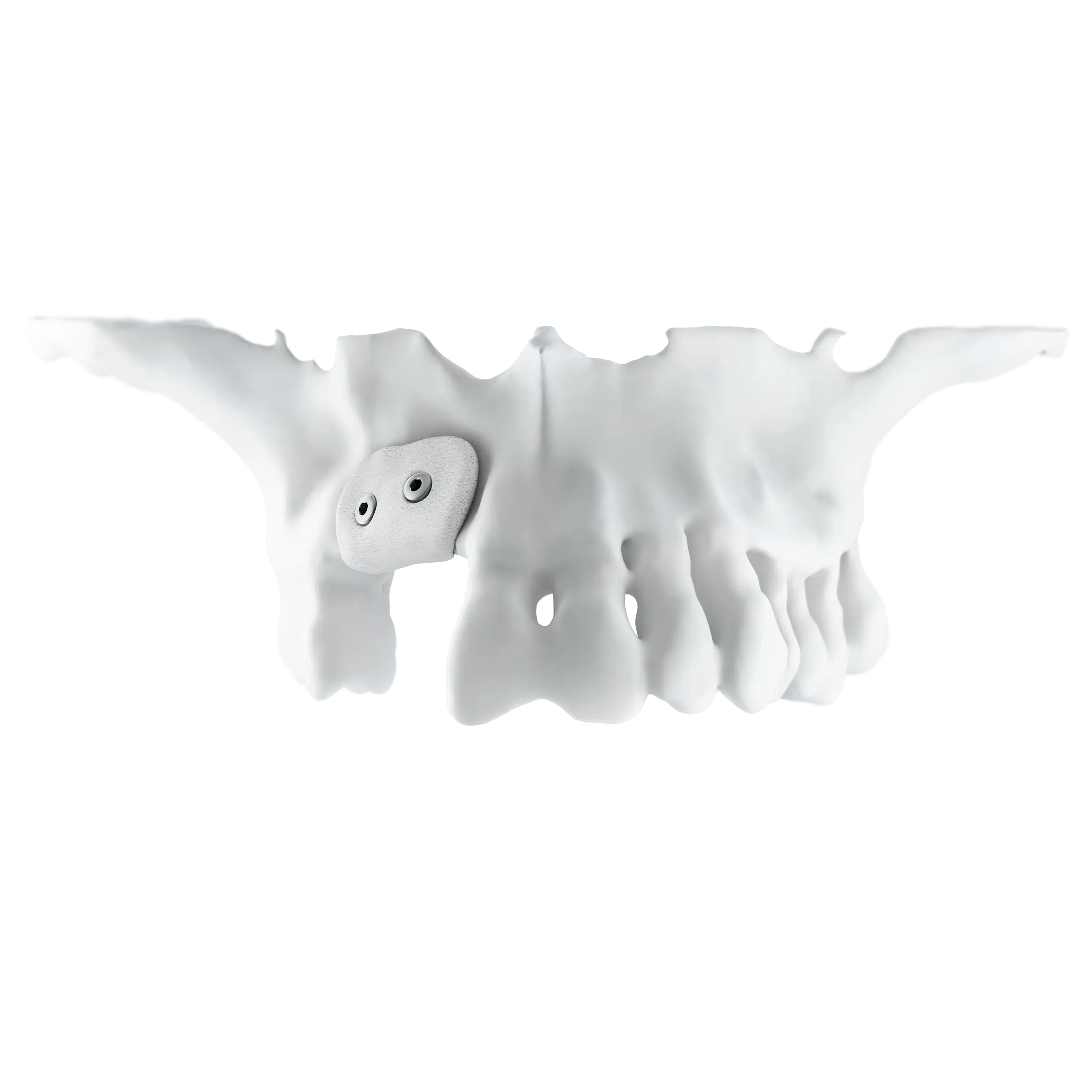 Maxillary bone graft for a 3D-BONE reconstruction