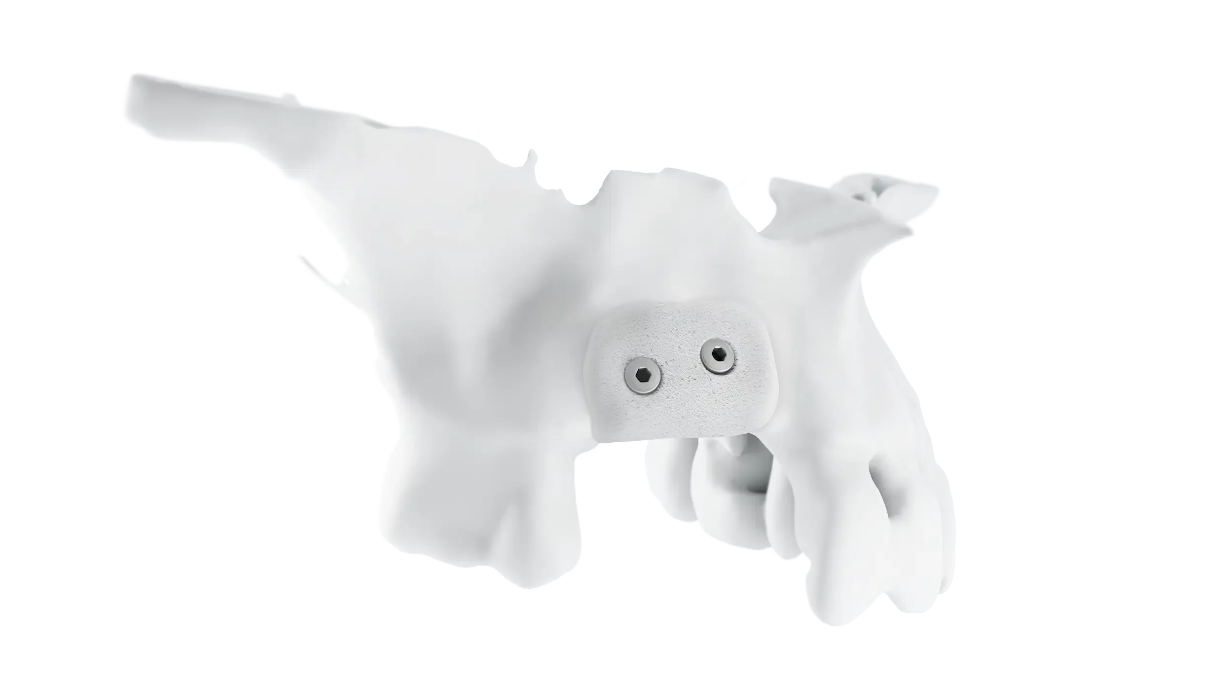 Patient-specific titanium mesh for a 3D-BONE case