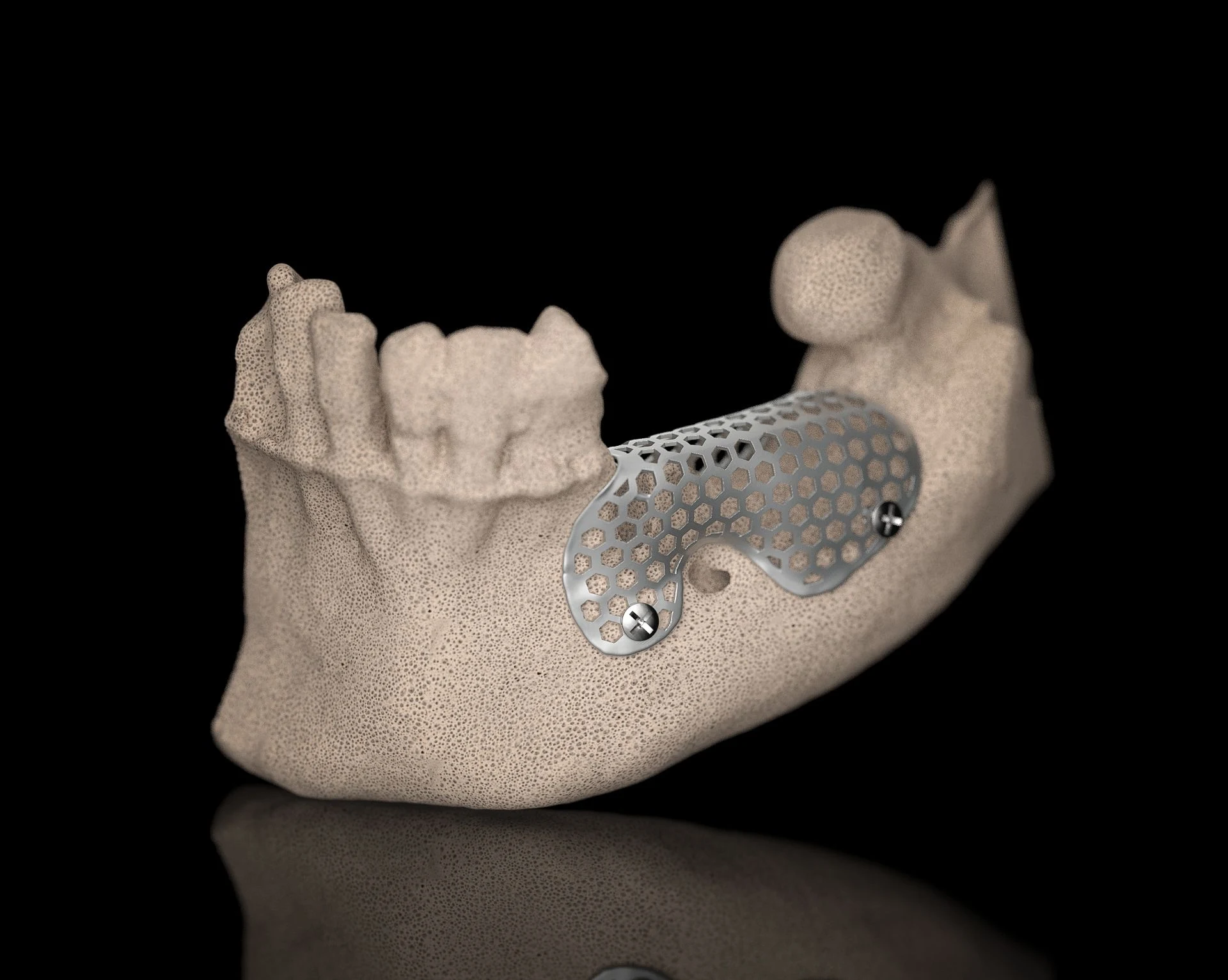 BTK titanium mesh fitted to a mandibular model for guided bone regeneration