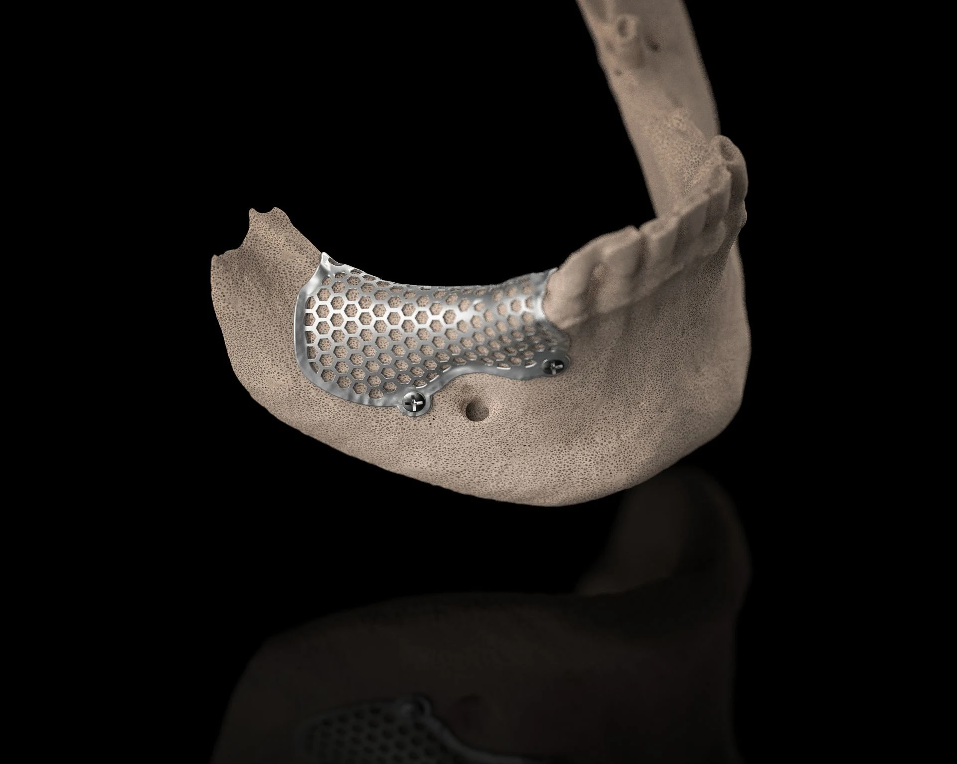 Custom BTK titanium mesh designed for mandibular bone regeneration