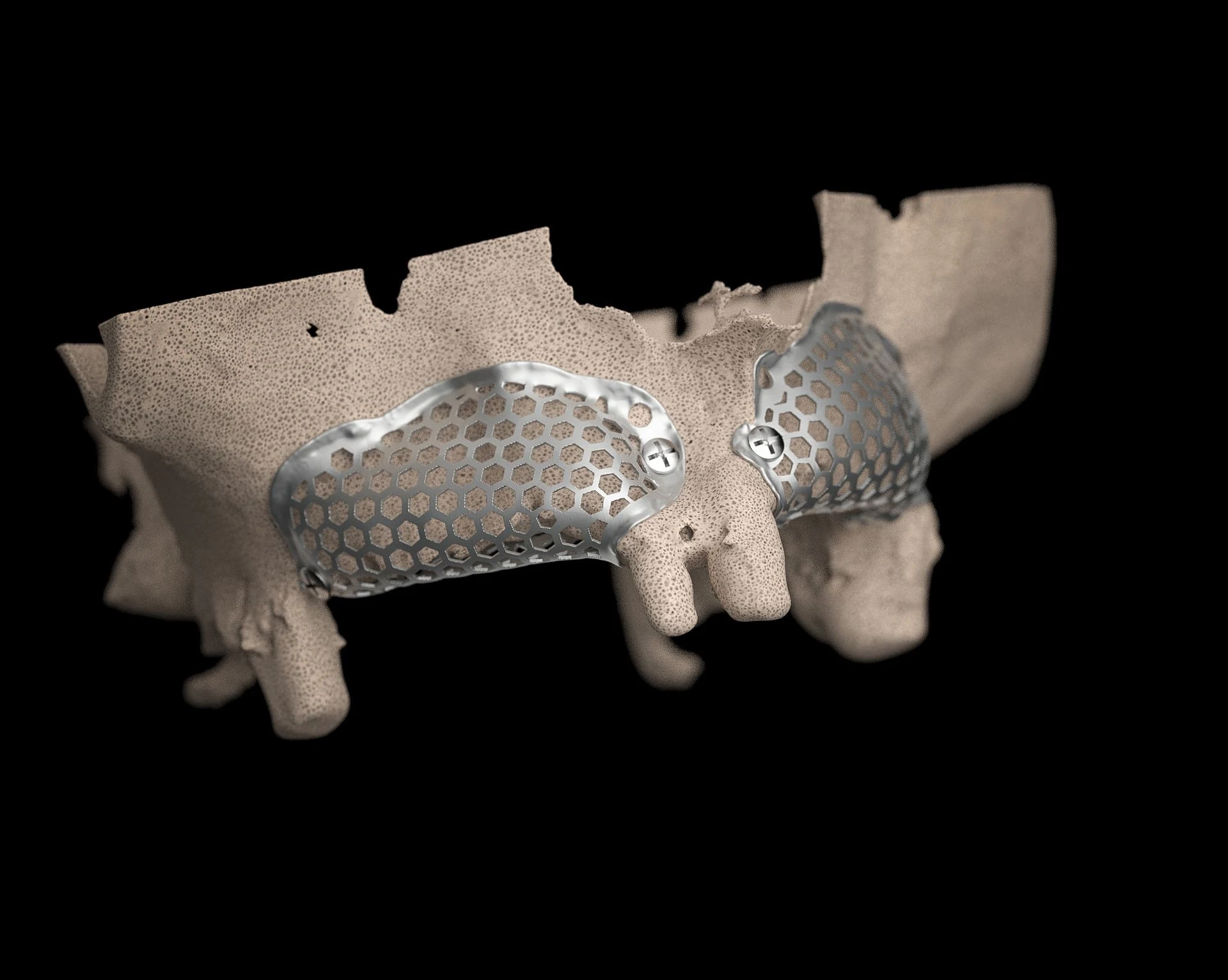 Custom BTK titanium mesh secured to a maxillary bone model