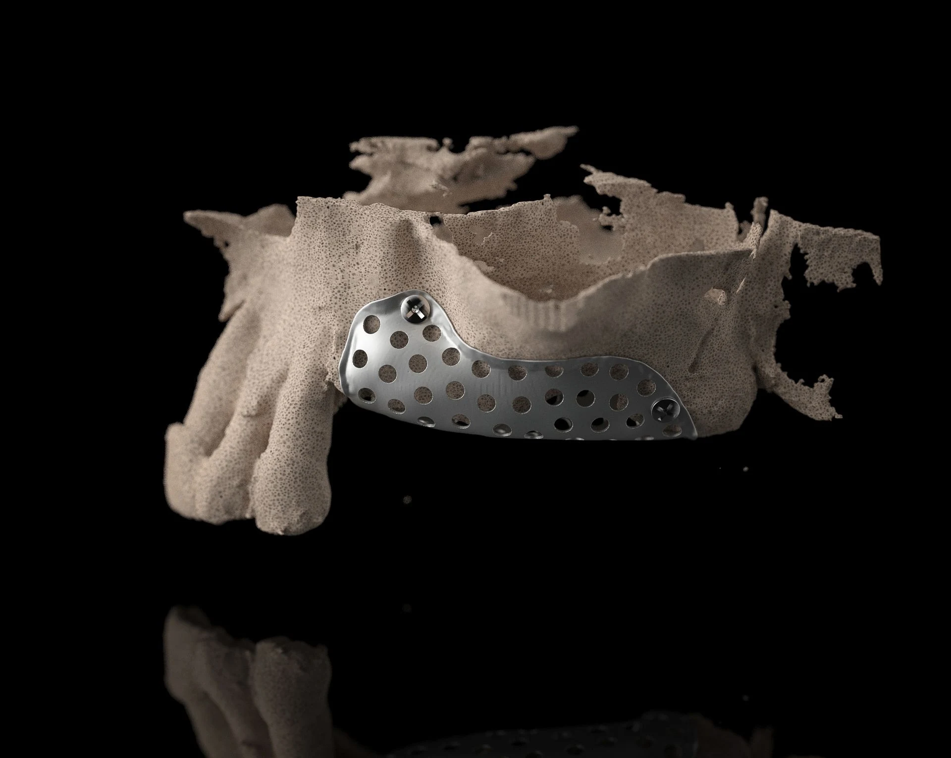 BTK titanium mesh adapted precisely to a jaw structure