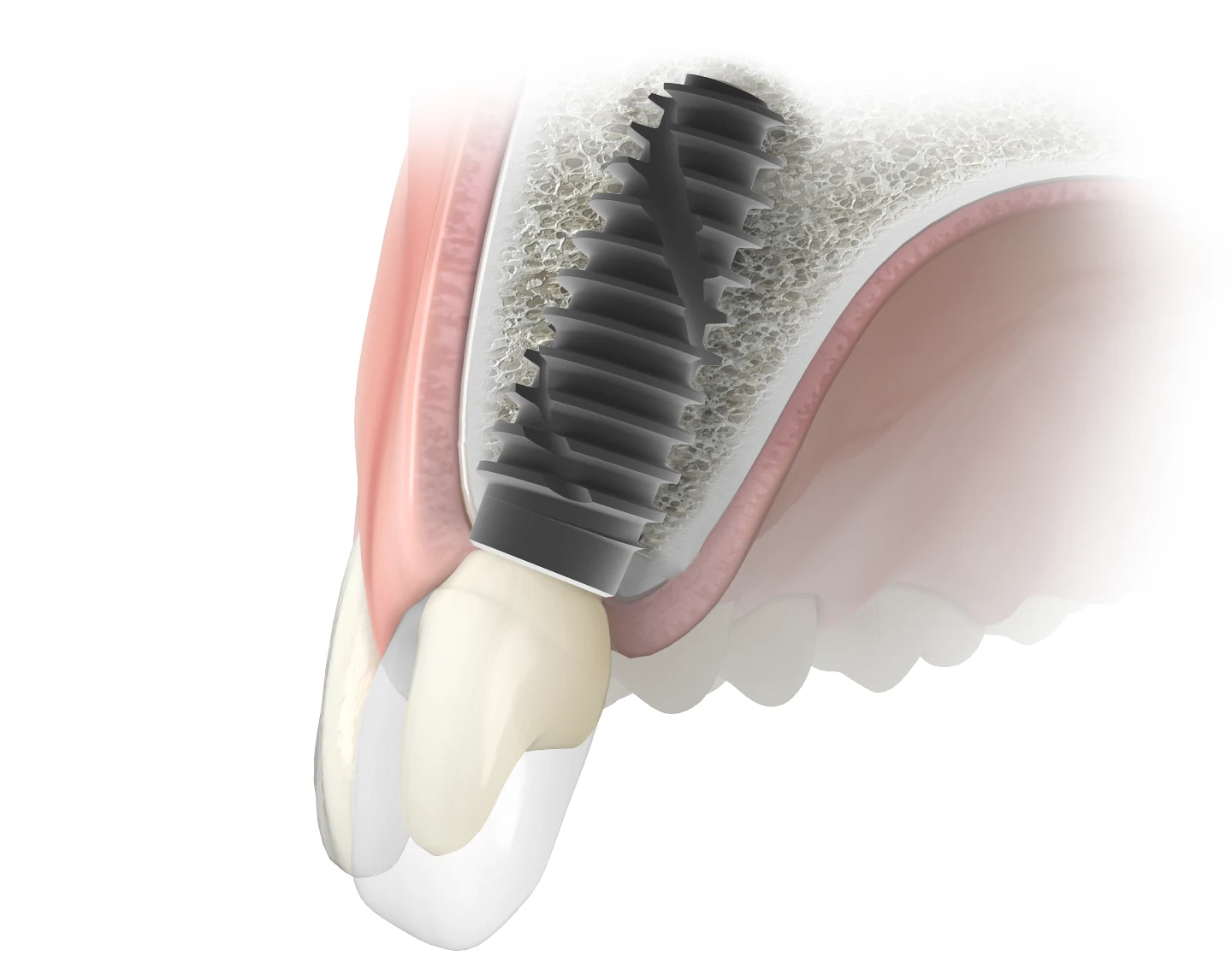 Cross-sectional illustration of a BTK IC+ implant integrated with jawbone tissue
