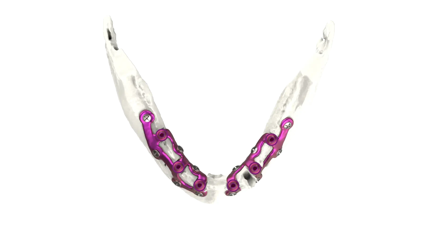 Lower jaw fixation plates for IUXTA-3D reconstruction
