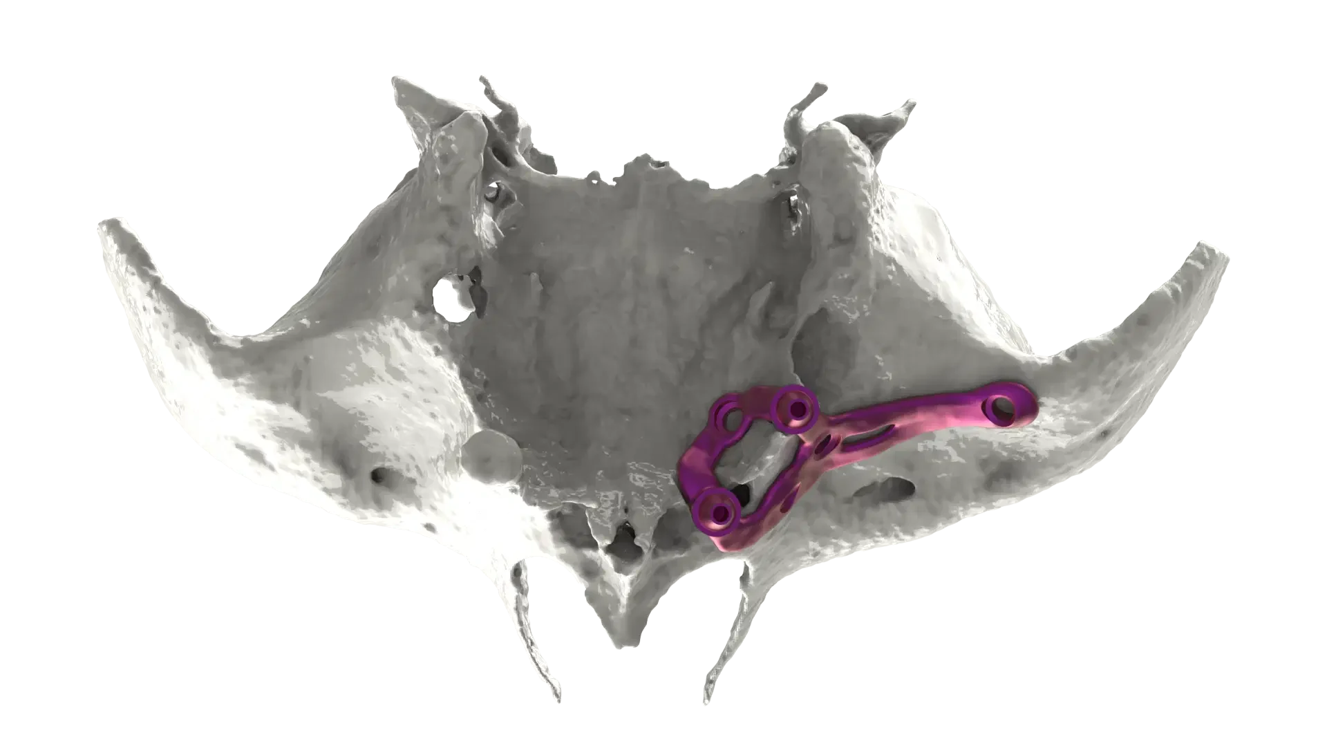 Maxillary model with a BTK zygomatic implant