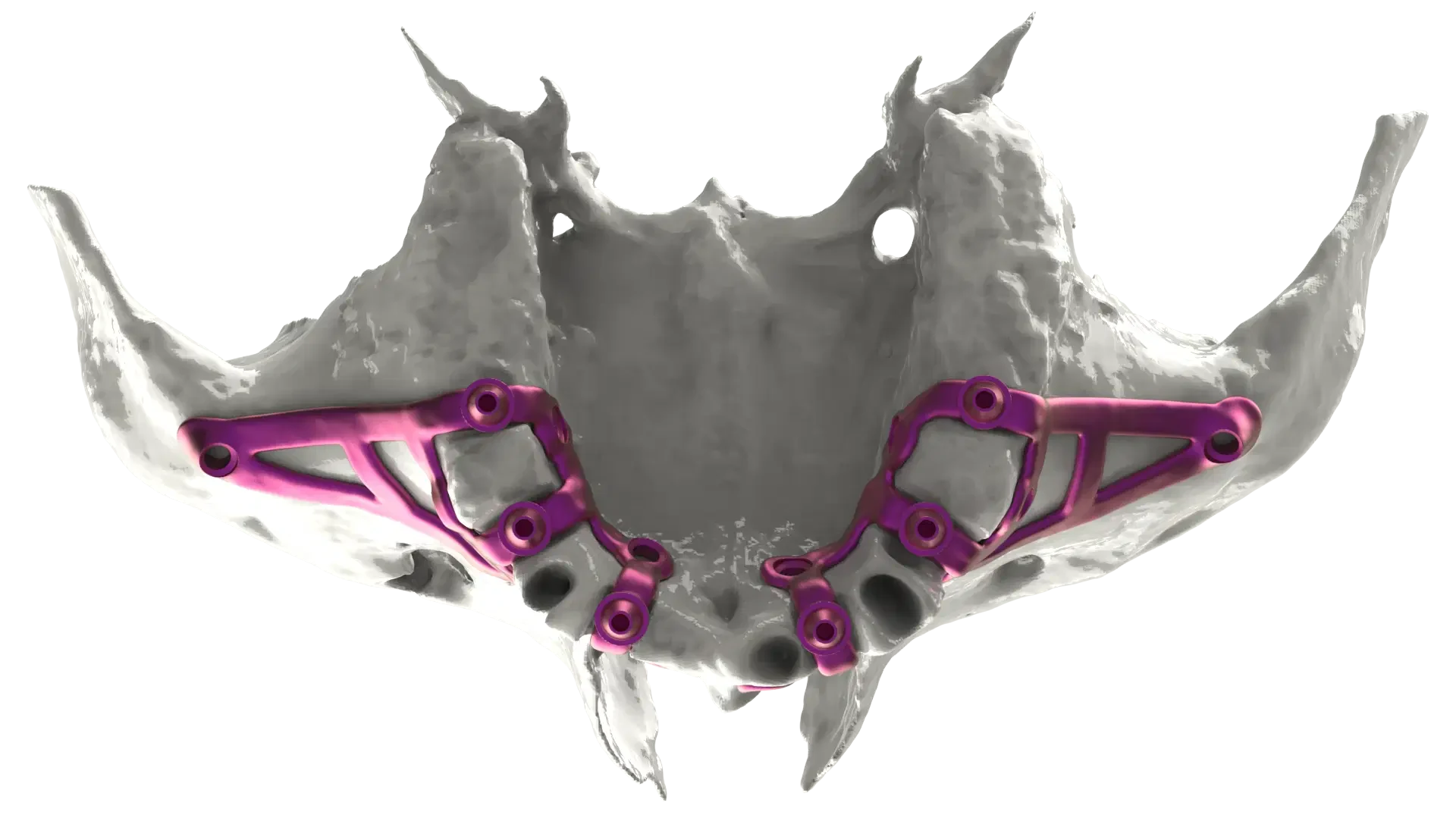 Patient-specific BTK surgical guide for IUXTA-3D planning