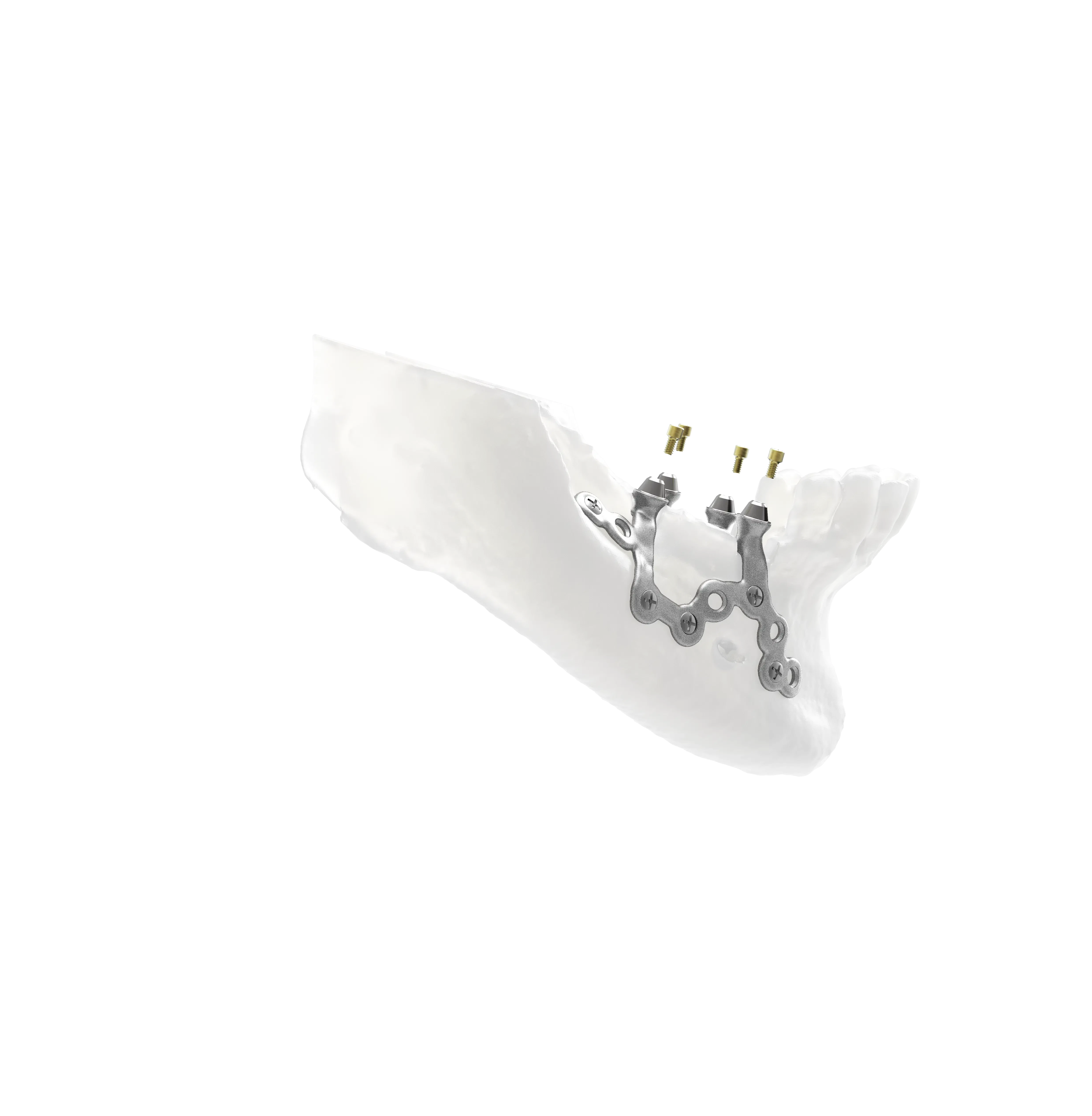 BTK mandibular reconstruction plate and fixation screws shown on a jawbone model